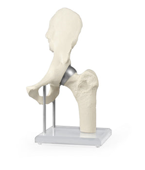 Hüftgelenk-Modell mit Schalenprothese